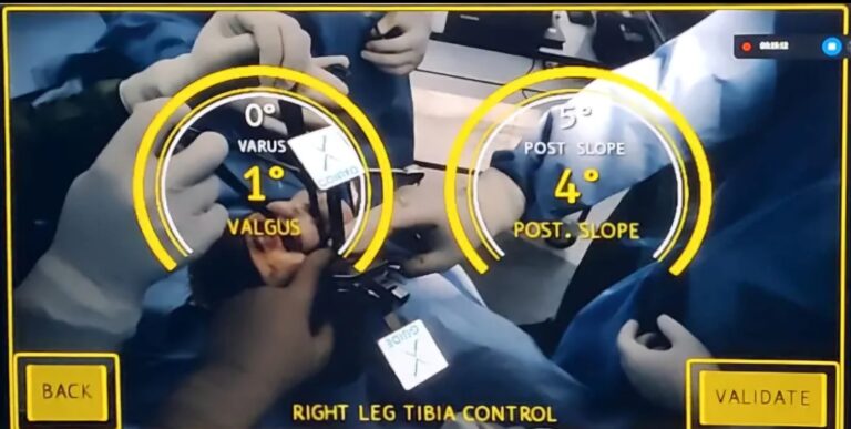 पारस अस्पताल ने रचा झारखंड में मेडिकल टेक्नोलॉजी का इतिहास